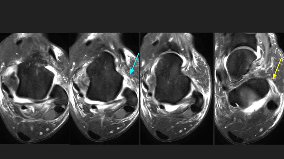 Figure 2 for case syndesmosis ( RID6088 )
